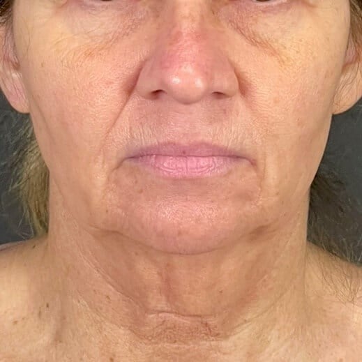 Facelift Before & After Image