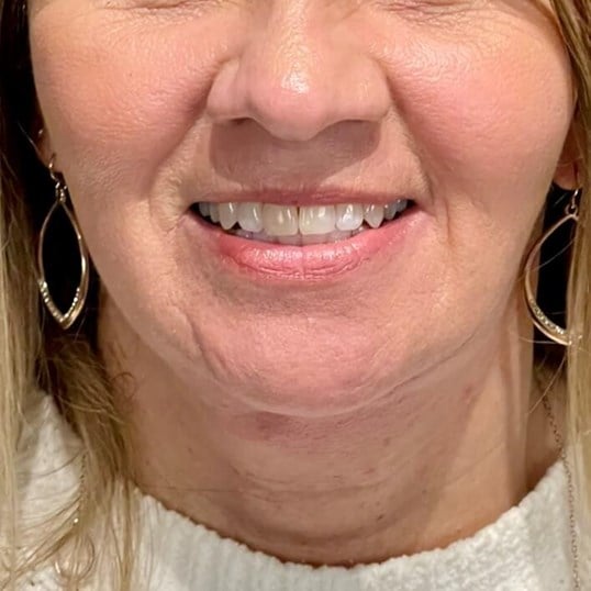 Facelift Before & After Image