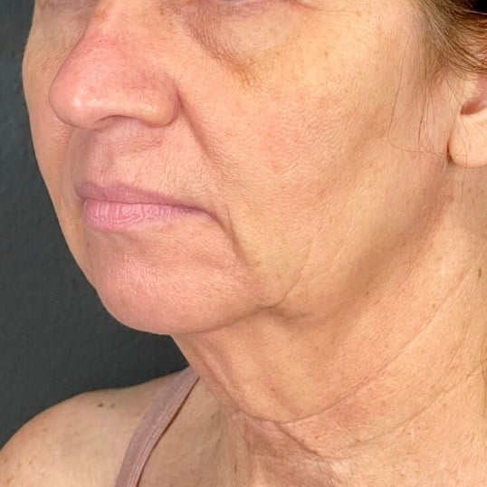 Facelift Before & After Image
