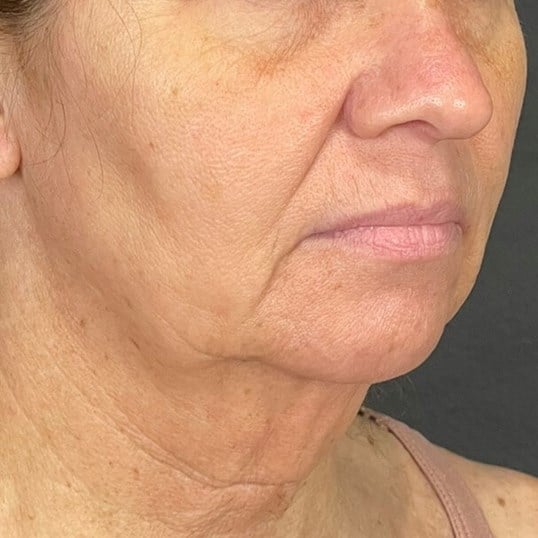 Facelift Before & After Image