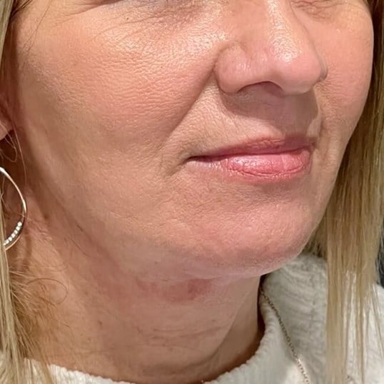 Facelift Before & After Image