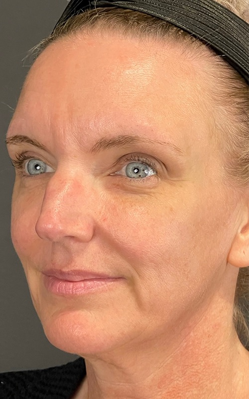 Facelift Before & After Image