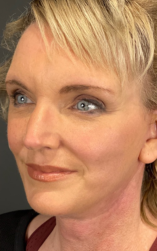 Facelift Before & After Image