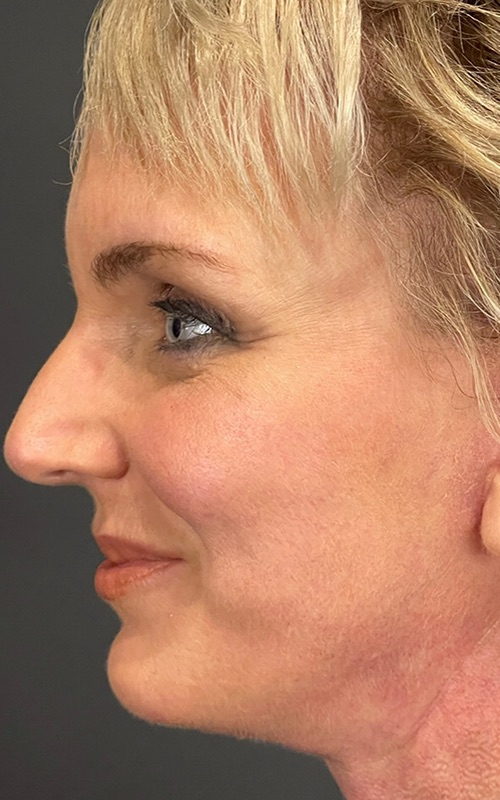 Facelift Before & After Image