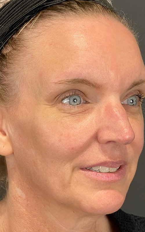 Facelift Before & After Image