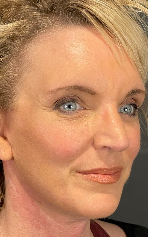 Facelift Before & After Image