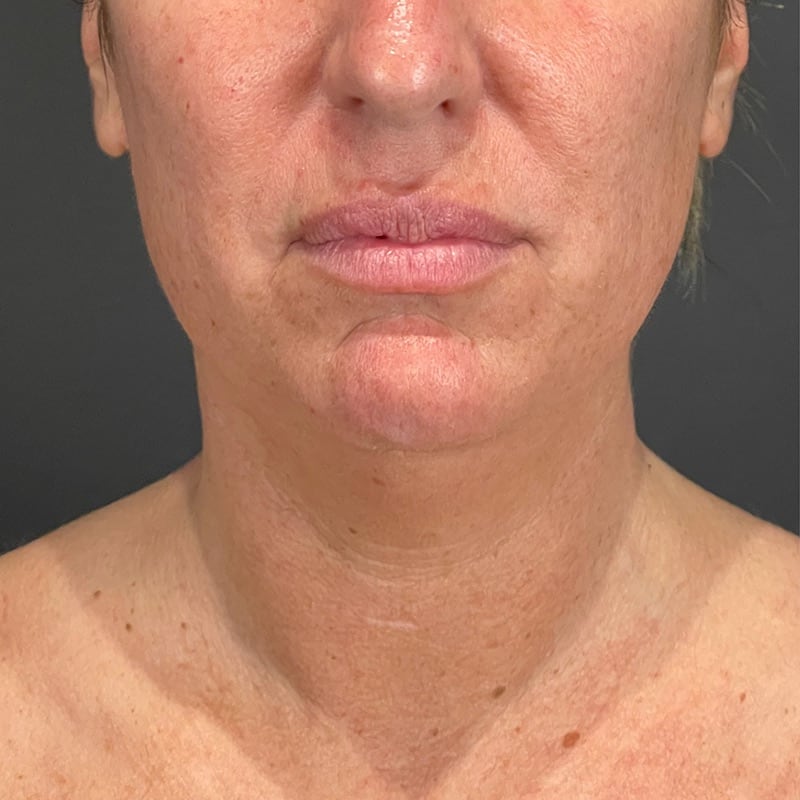 Facelift Before & After Image