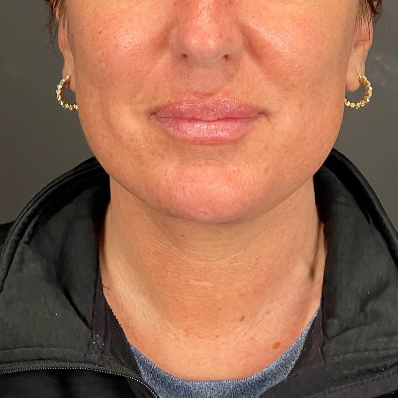 Facelift Before & After Image
