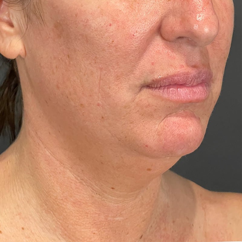 Facelift Before & After Image