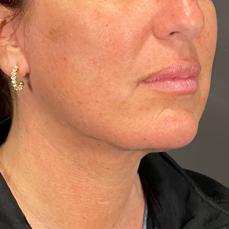 Facelift Before & After Image