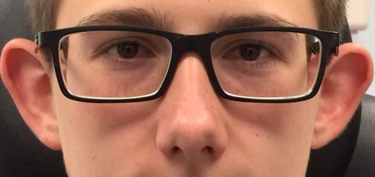 Otoplasty Before & After Image