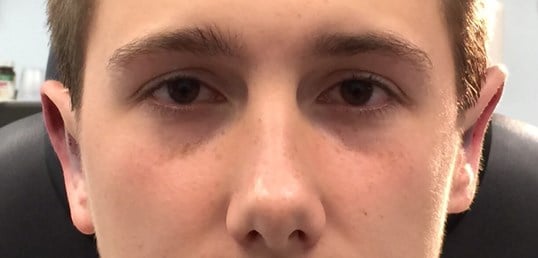 Otoplasty Before & After Image