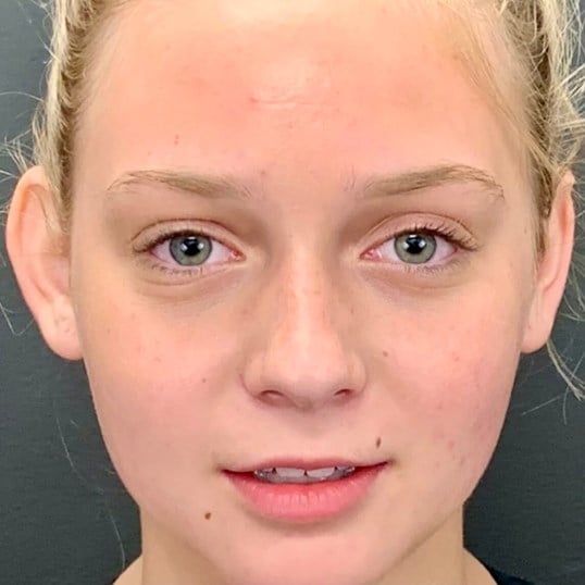 Otoplasty Before & After Image