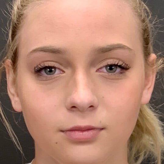 Otoplasty Before & After Image