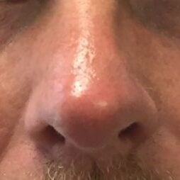 Rhinoplasty Before & After Image