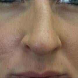 Rhinoplasty Before & After Image