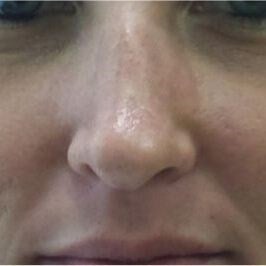 Rhinoplasty Before & After Image