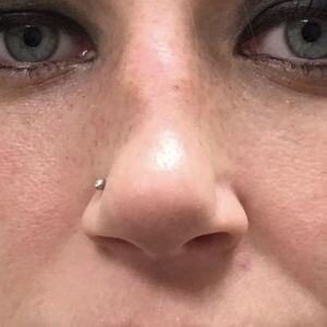 Rhinoplasty Before & After Image