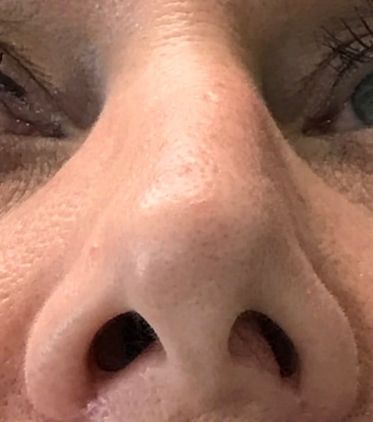 Rhinoplasty Before & After Image