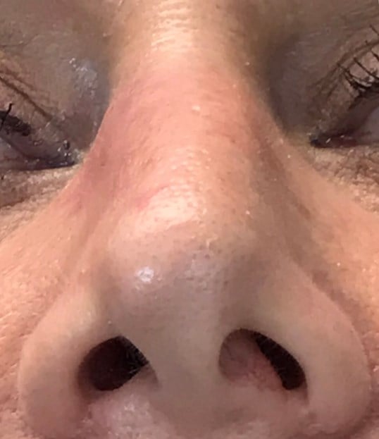 Rhinoplasty Before & After Image