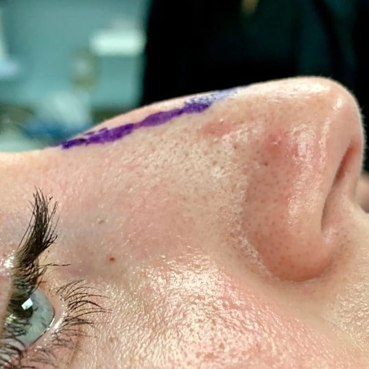 Rhinoplasty Before & After Image