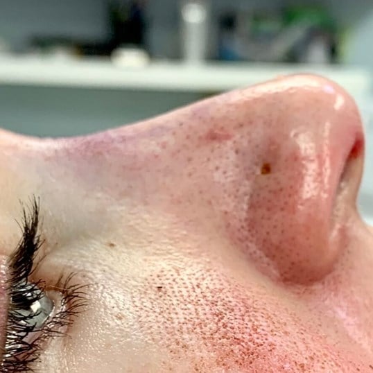 Rhinoplasty Before & After Image