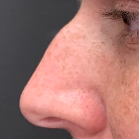 Rhinoplasty Before & After Image