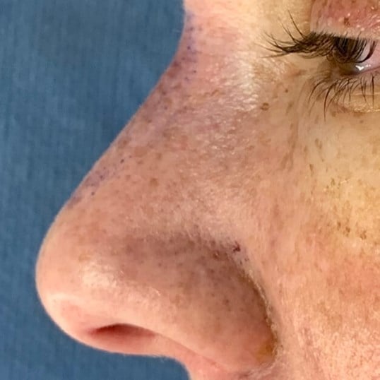 Rhinoplasty Before & After Image