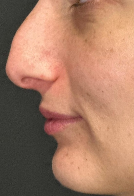 Rhinoplasty Before & After Image