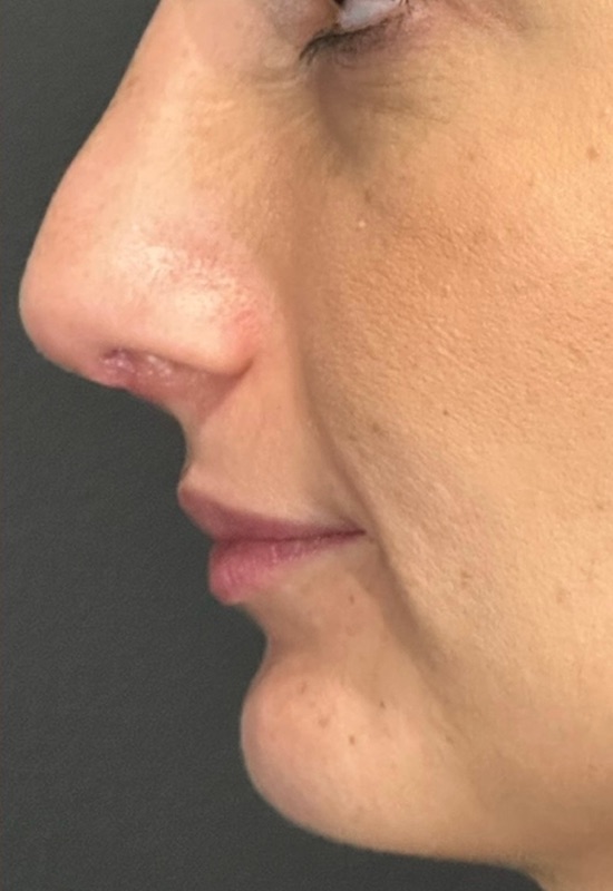 Rhinoplasty Before & After Image