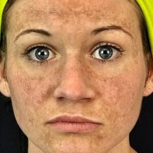 Ipl Before & After Image