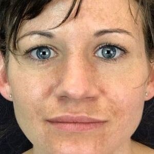 Ipl Before & After Image