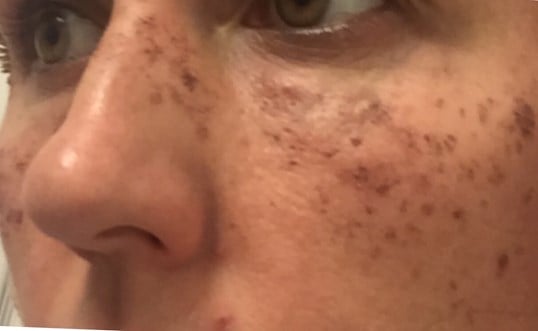 Ipl Before & After Image