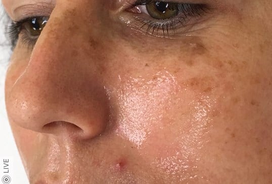 Ipl Before & After Image