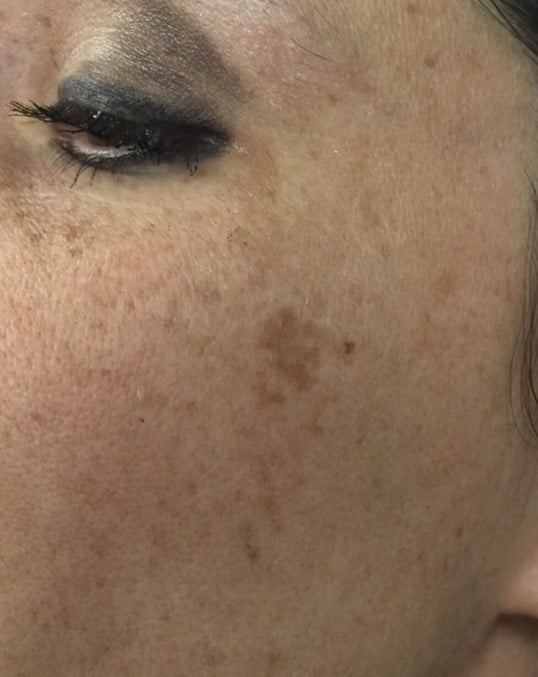 Ipl Before & After Image