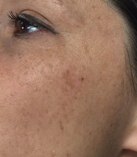 Ipl Before & After Image