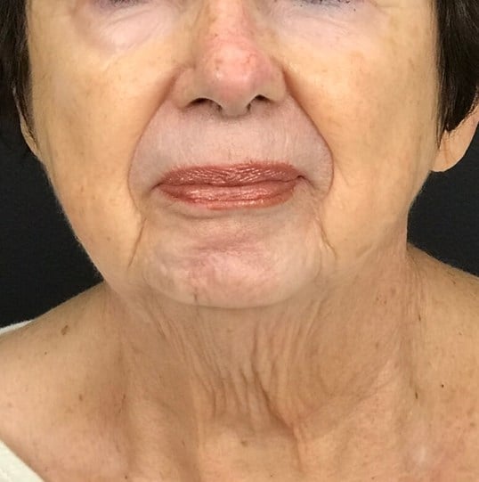 Laser Skin Resurfacing Before & After Image