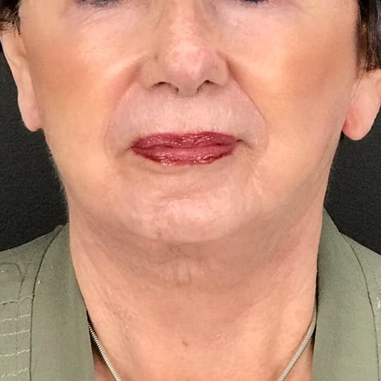 Laser Skin Resurfacing Before & After Image