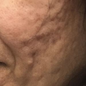 Laser Skin Resurfacing Before & After Image