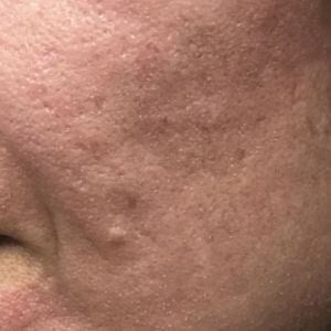 Laser Skin Resurfacing Before & After Image