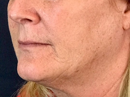 Laser Skin Resurfacing Before & After Image