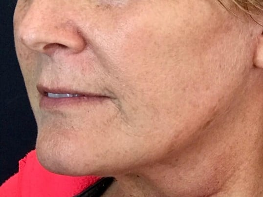 Laser Skin Resurfacing Before & After Image