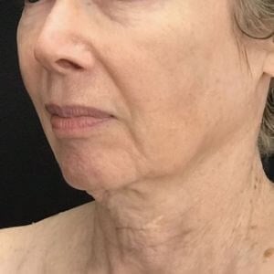 Laser Skin Resurfacing Before & After Image