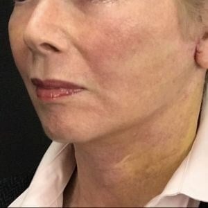 Laser Skin Resurfacing Before & After Image