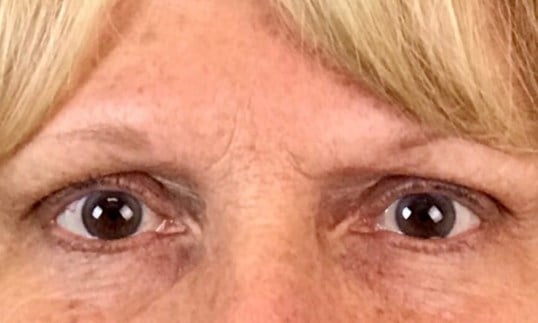 Laser Skin Resurfacing Before & After Image