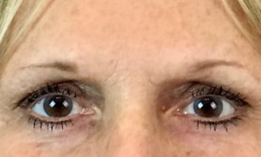Laser Skin Resurfacing Before & After Image