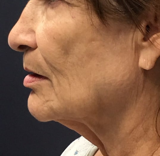 Laser Skin Resurfacing Before & After Image