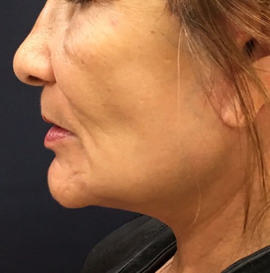 Laser Skin Resurfacing Before & After Image