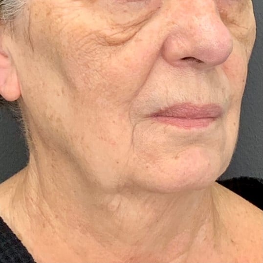 Laser Skin Resurfacing Before & After Image