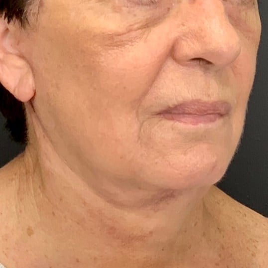 Laser Skin Resurfacing Before & After Image